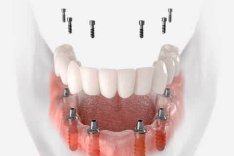 13-guide-implant-dentaire