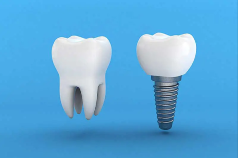 SINGLE UNIT IMPLANTS
