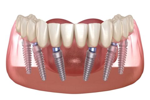 all-on-6-dental-implants-