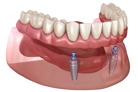 implant-supported-overdenture-1080x675