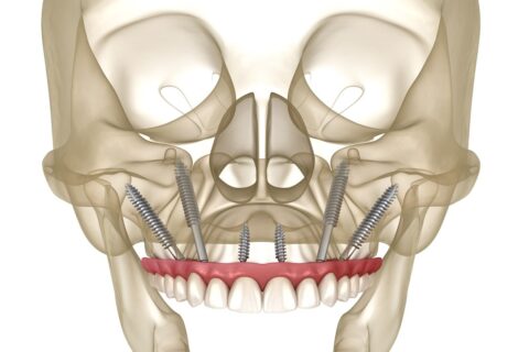 zygomatic-dental-implants